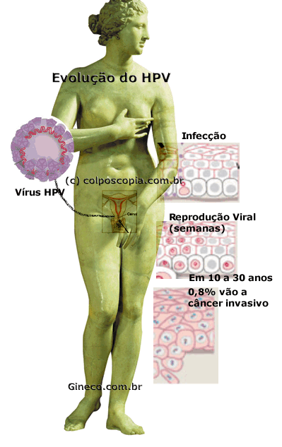 Como o HPV se transforma em cncer de colo uterino